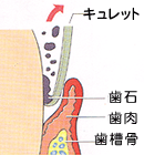 ルートプレーニングによる治療法