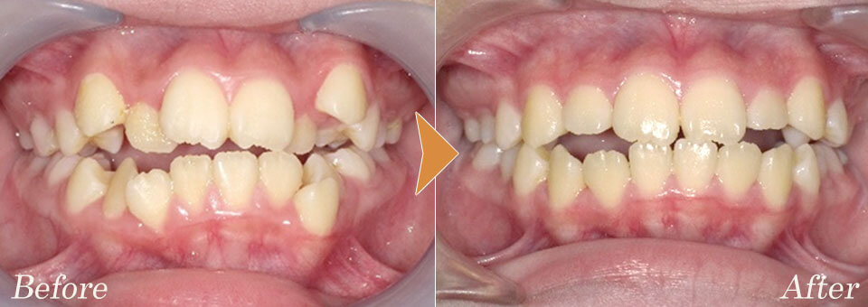 小児矯正歯科症例3